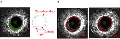 Quantifying Patient-Specific in vivo Coronary Plaque Material Properties for Accurate Stress/Strain Calculations: An IVUS-Based Multi-Patient Study